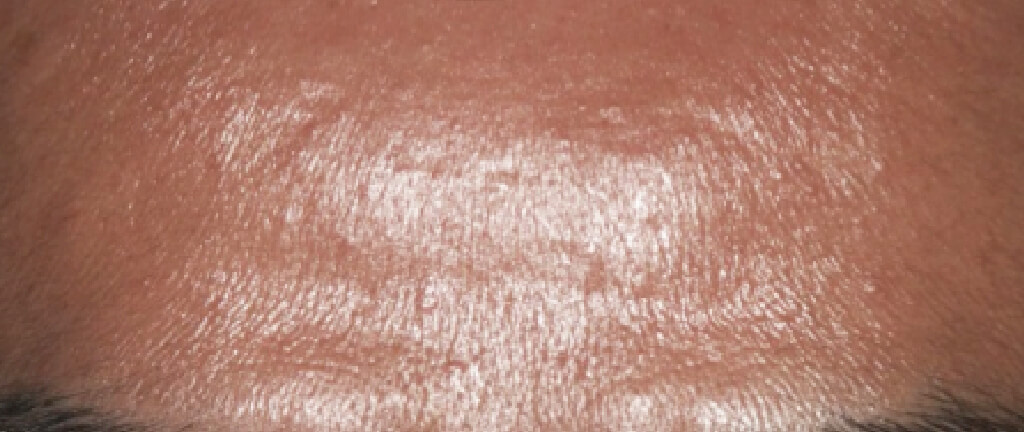 skin of middle-aged men that increased glitter